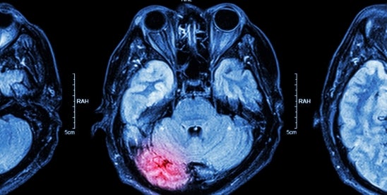 Traumatic brain injury effects on employment and income loss