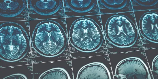 Oklahoma Court Affirms Admissibility of DTI-Based TBI Diagnosis in Federal Case