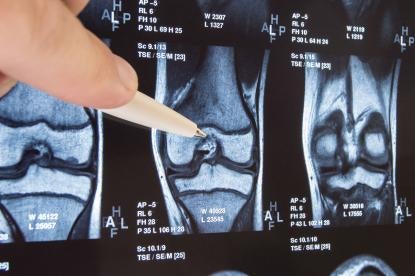 X-ray Exactech Hip, Knee and Ankle Replacement Lawsuits