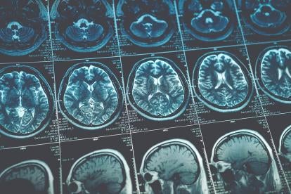 MRI, Patent Infringement, brain scans